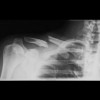 Clavicle Fracture - Broken Collarbone